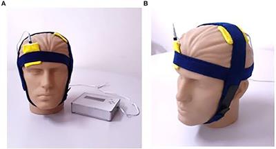 Transcranial Direct Current Stimulation and Mirror Therapy for Neuropathic Pain After Brachial Plexus Avulsion: A Randomized, Double-Blind, Controlled Pilot Study